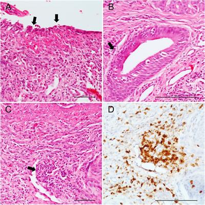 Inflammatory Profiles of Tracheal Biopsies From SARS-CoV-2 Patients